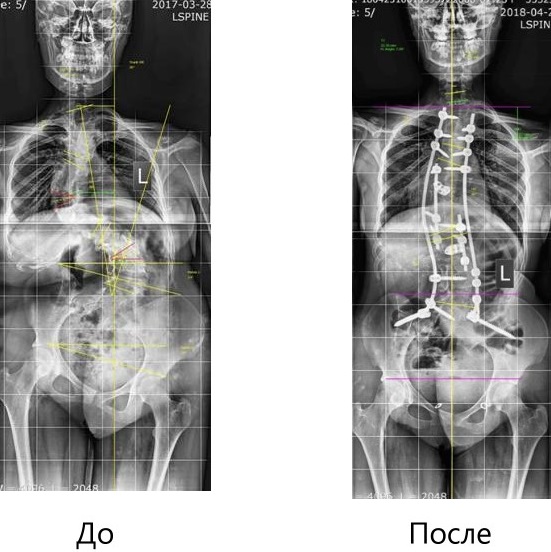 Нижегородские нейрохирурги провели 11-часовую операцию по устранению деформации позвоночника - фото 1